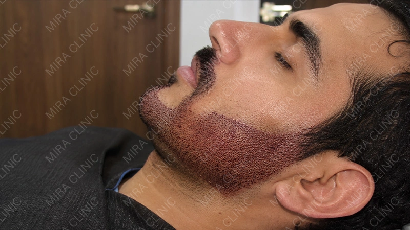 facial hair restoration